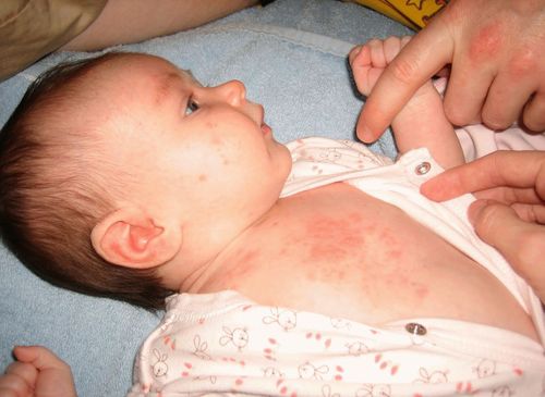 Алергия у младенца